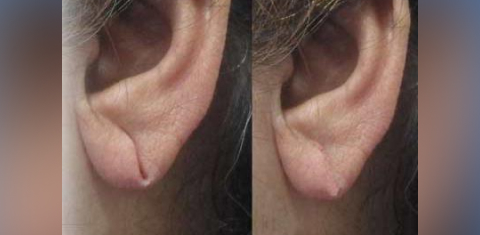 Blepharoplasty