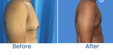Blepharoplasty