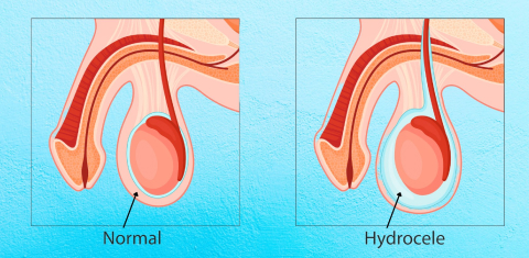 Rhinoplasty