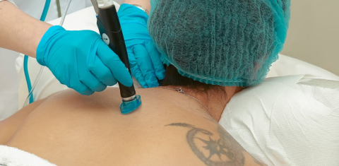 Hair Transplant